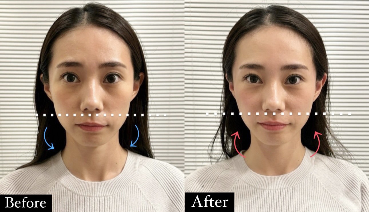 小顔矯正